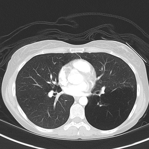 Bronchial atresia (Radiopaedia 73677-84470 Axial lung window 34).jpg