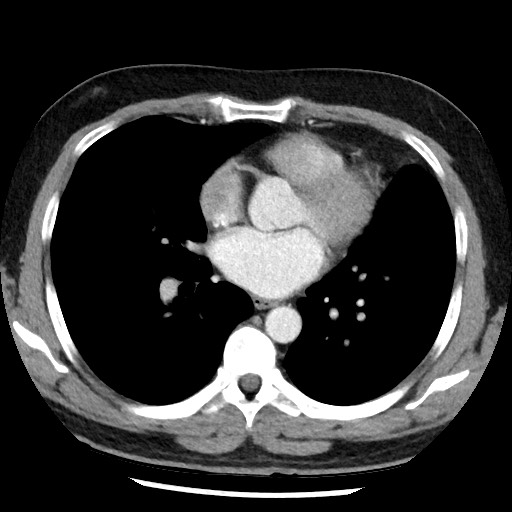 Bronchial carcinoid tumor (Radiopaedia 67377-76764 A 36).jpg