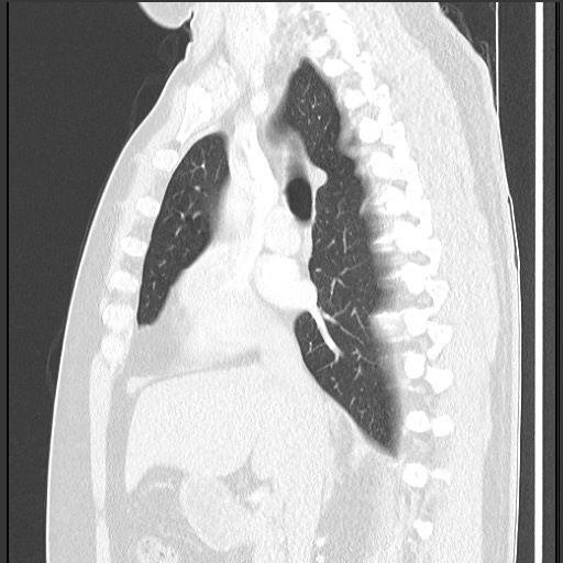 Bronchial carcinoid tumor (Radiopaedia 67377-76764 Sagittal lung window 31).jpg