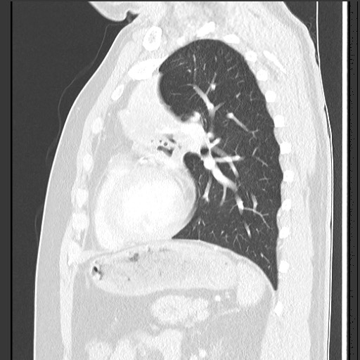 Bronchial carcinoid tumor (Radiopaedia 67377-76764 Sagittal lung window 46).jpg