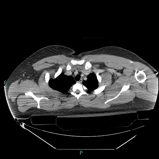 Bronchial carcinoid tumor (Radiopaedia 78272-90870 C 25).jpg