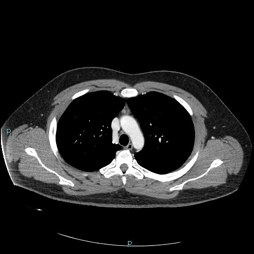 Bronchial carcinoid tumor (Radiopaedia 78272-90875 A 34).jpg