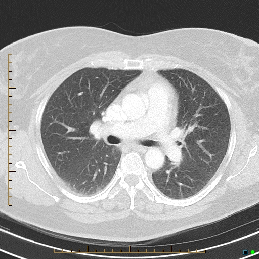 Bronchial diverticula (Radiopaedia 79512-92675 Axial lung window 21).jpg