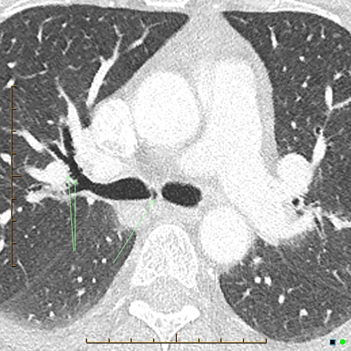 File:Bronchial diverticula (Radiopaedia 79512-92677 Axial lung window 8).jpg