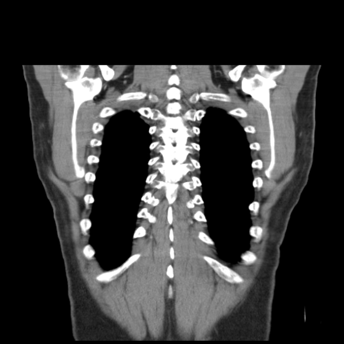 Bronchogenic carcinoma with upper lobe collapse (Radiopaedia 29297-29726 D 48).jpg