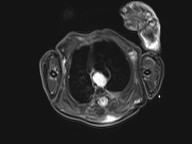 File:Bronchogenic cyst (Radiopaedia 27207-27380 Axial STIR 10).jpg