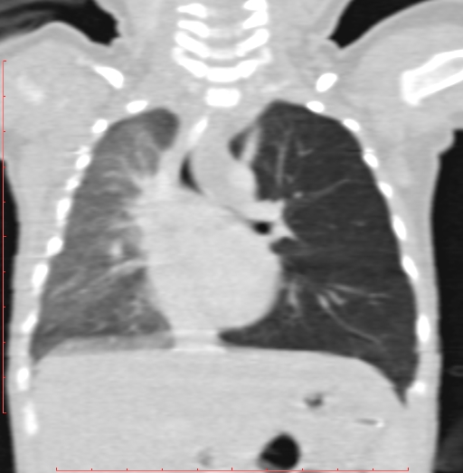 Bronchogenic cyst (Radiopaedia 78599-91409 Coronal lung window 121).jpg