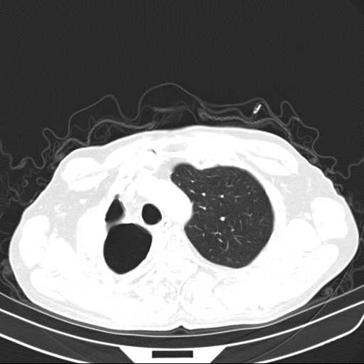 File:Bronchopleural fistula - postoperative complication (Radiopaedia 21020-20947 Axial lung window 12).jpg