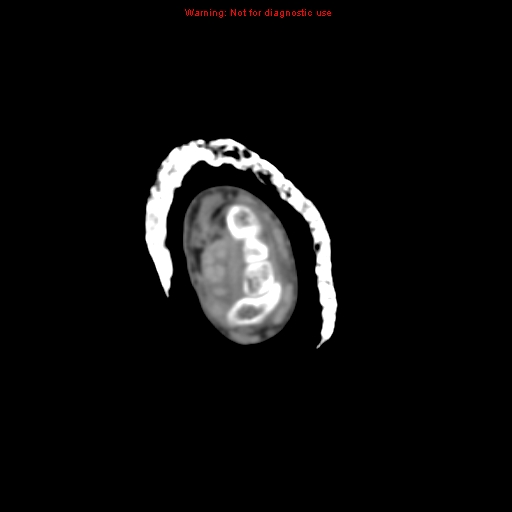 Brown tumor (Radiopaedia 12460-12694 Axial non-contrast 10).jpg