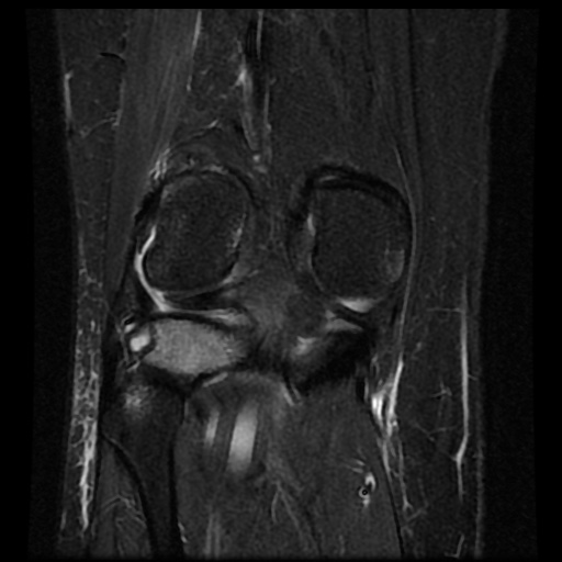 File:Bucket handle meniscus tear (Radiopaedia 56916-63751 Coronal STIR 15).jpg