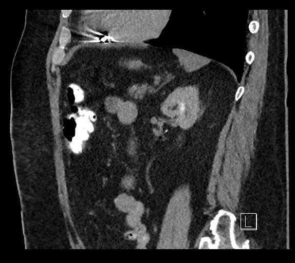 Buried bumper syndrome - gastrostomy tube (Radiopaedia 63843-72577 Sagittal Inject 38).jpg