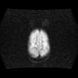 File:Burkitt lymphoma of the orbit- pre and post chemotherapy (Radiopaedia 31214-31929 Axial DWI 15).jpg