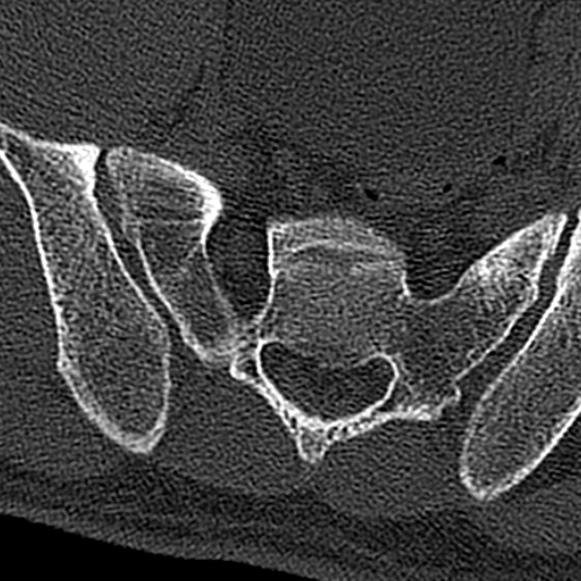 File:Burst fracture (Radiopaedia 53373-59357 Axial bone window 77).jpg