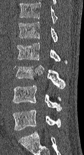 Burst fracture (Radiopaedia 53373-59357 Sagittal bone window 33).jpg
