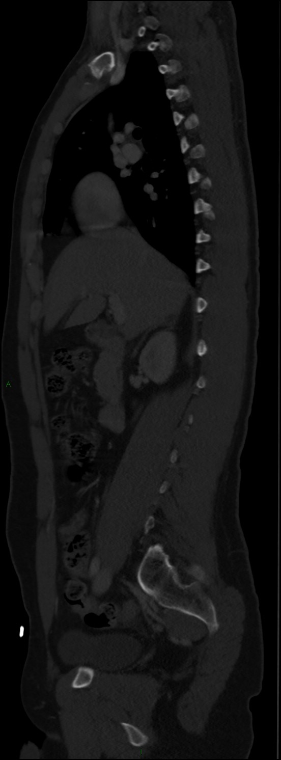 Burst fracture (Radiopaedia 83168-97542 Sagittal bone window 56).jpg