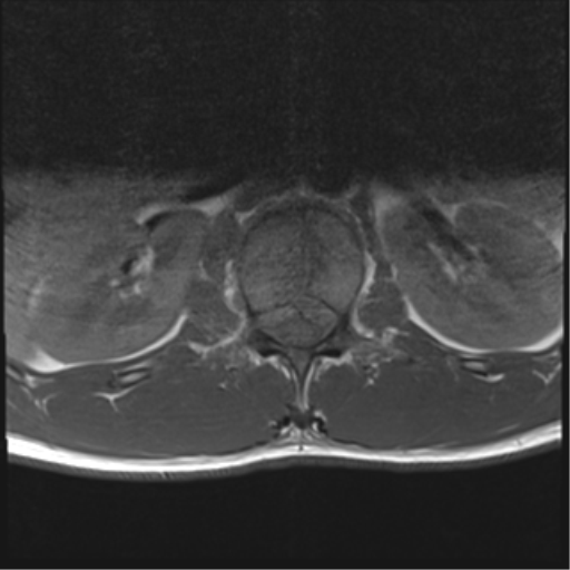 File:Burst fracture - T12 with conus compression (Radiopaedia 56825-63646 Axial T1 13).png