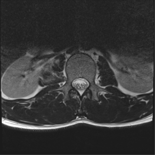 File:Burst fracture - T12 with conus compression (Radiopaedia 56825-63646 Axial T2 8).png
