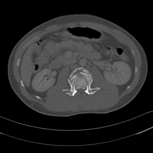 Burst fracture with cauda equina syndrome (Radiopaedia 25701-25867 Axial bone window 36).jpg