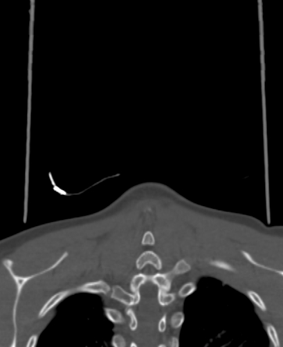 Butterfly vertebra (Radiopaedia 77903-90209 Coronal bone window 101).jpg