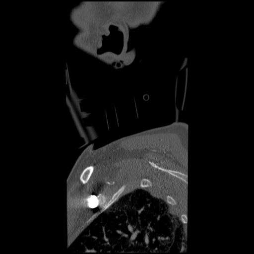 File:C1 anterior arch (plough) fracture - type 1 (Radiopaedia 76181-87720 Sagittal bone window 1).jpg