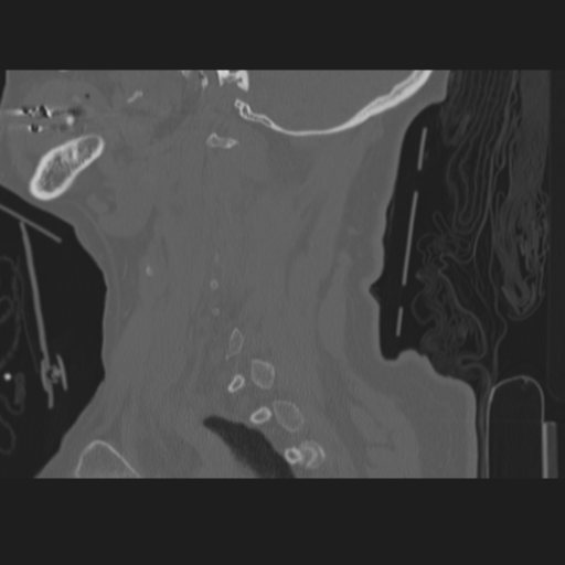 File:C2 fracture (Radiopaedia 34091-35341 Sagittal bone window 19).png