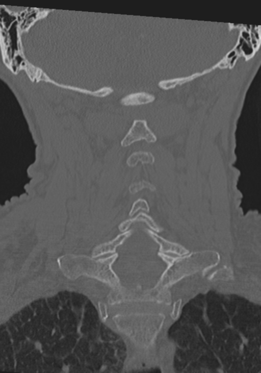 C2 fracture with vertebral artery dissection (Radiopaedia 37378-39199 Coronal bone window 33).png