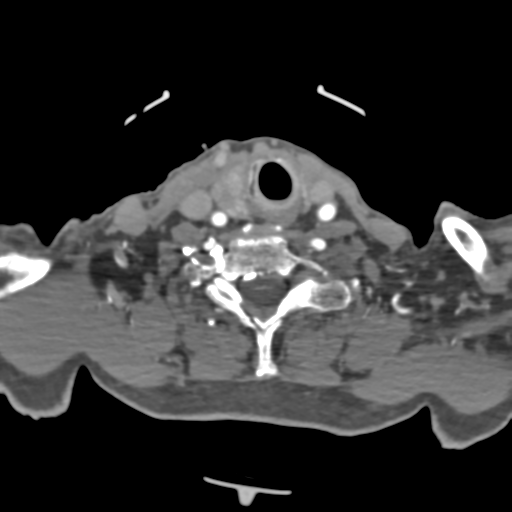 File:C2 fracture with vertebral artery dissection (Radiopaedia 37378-39200 A 92).png