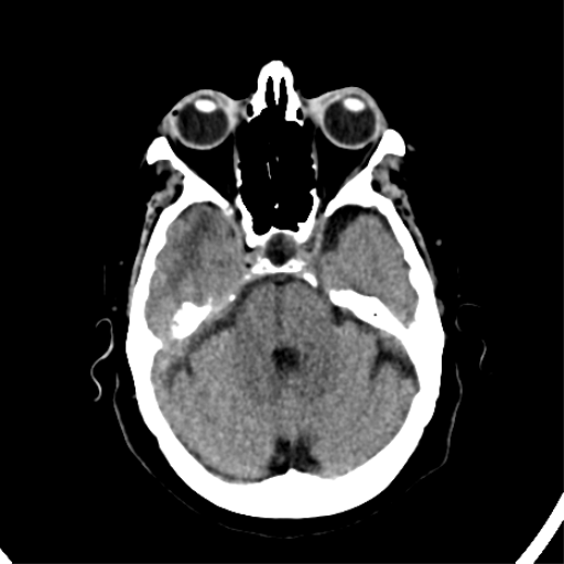 File:CNS Lymphoma (Radiopaedia 44198-47794 Axial non-contrast 12).png