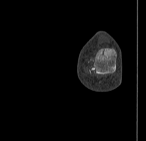 Calcaneal fracture - Sanders type 4 (Radiopaedia 90179-107370 Coronal bone window 88).jpg