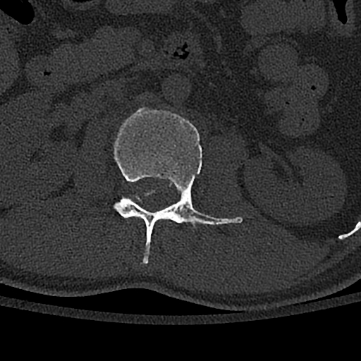 Calcaneal fractures with associated L2 burst fracture (Radiopaedia 71671-82493 Axial bone window 41).jpg