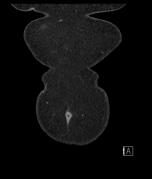 Calcified adrenal glands and Spigelian hernia (Radiopaedia 49741-54988 B 6).jpg