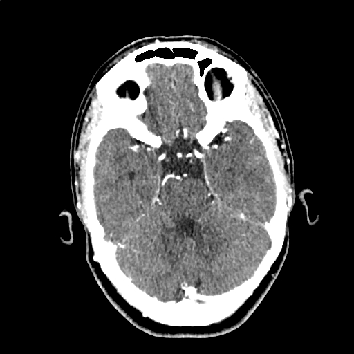 Calcified cerebral hydatid cyst (Radiopaedia 65603-74717 Axial with contrast 21).jpg