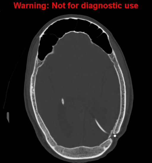 Calvarial thickening from chronic shunting (Radiopaedia 60079-67637 Axial bone window 91).jpg