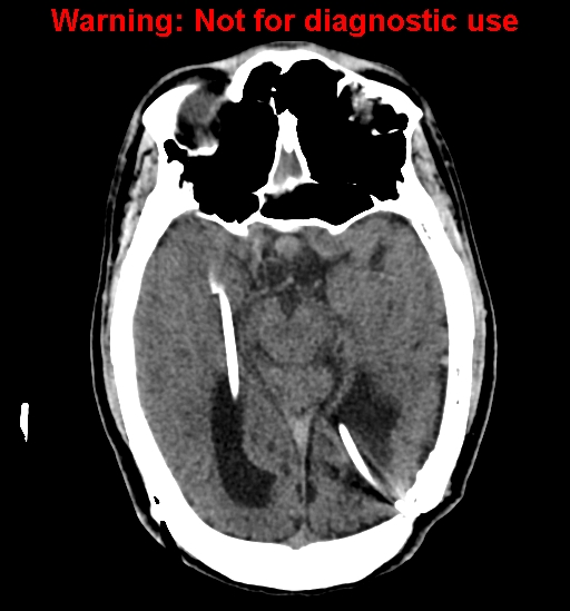 File:Calvarial thickening from chronic shunting (Radiopaedia 60079-67637 Axial non-contrast 14).jpg