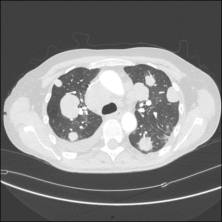 Cannonball metastases (Radiopaedia 82110-96150 Axial lung window 72).jpg