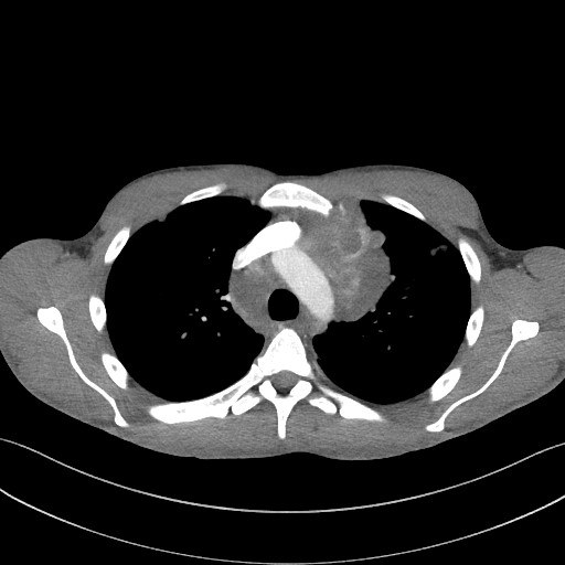 Cannonball metastases - testicular choriocarcinoma (Radiopaedia 84510-99891 B 41).jpg