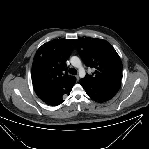 File:Cannonball pulmonary metastases (Radiopaedia 67684-77101 D 98).jpg