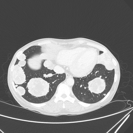 Canonball lung metastasis (Radiopaedia 77634-89837 Axial lung window 138).jpg