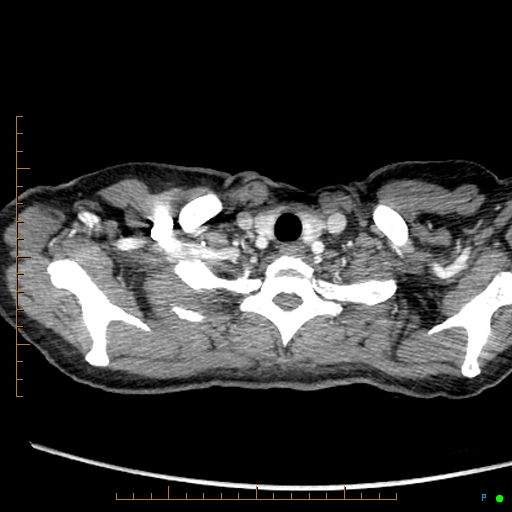 Canonball lung metastasis (Radiopaedia 77634-89837 B 1).jpg