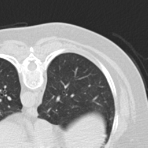 Carcinoid tumor - lung (Radiopaedia 44814-48644 Axial lung window 66).png