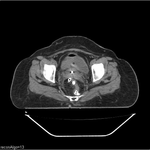 Carcinoma cervix- brachytherapy applicator (Radiopaedia 33135-34173 Axial non-contrast 30).jpg