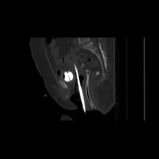 Carcinoma cervix- brachytherapy applicator (Radiopaedia 33135-34173 Sagittal bone window 89).jpg