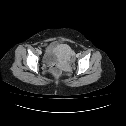 Carcinoma colon - hepatic flexure (Radiopaedia 19461-19493 A 117).jpg