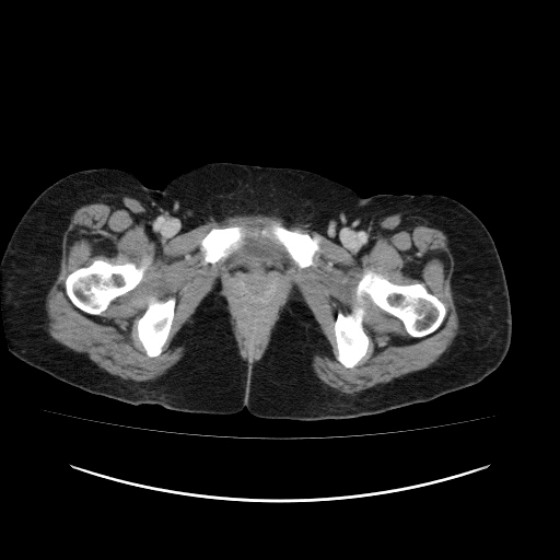 Carcinoma colon - hepatic flexure (Radiopaedia 19461-19493 A 131).jpg