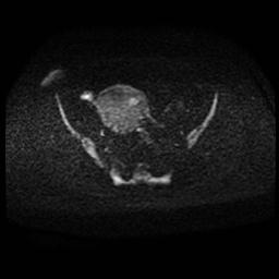 Carcinoma of the cervix (Radiopaedia 89018-105858 Axial DWI 58).jpg