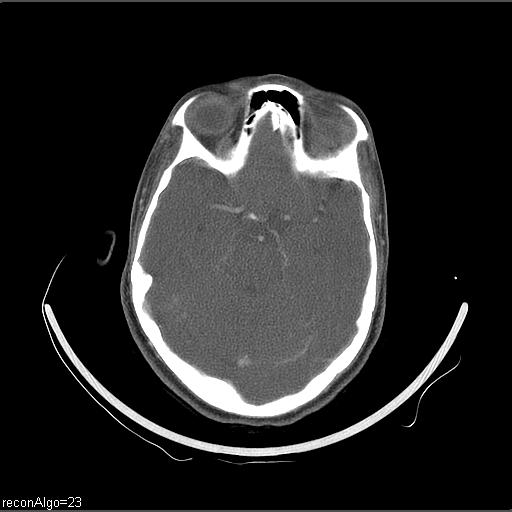File:Carcinoma of the maxillary antrum (Radiopaedia 53805-59888 Axial C+ delayed 70).jpg