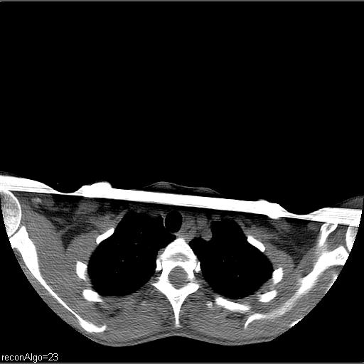 Carcinoma of the maxillary antrum (Radiopaedia 53805-59888 Axial non-contrast 1).jpg