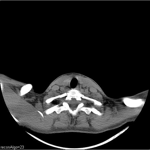 File:Carcinoma of the maxillary antrum (Radiopaedia 53805-59888 Axial non-contrast 11).jpg