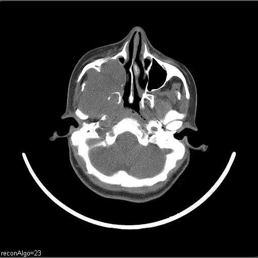 Carcinoma of the maxillary antrum (Radiopaedia 53805-59888 Axial non-contrast 62).jpg
