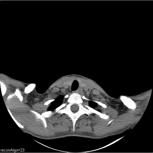 Carcinoma of the maxillary antrum (Radiopaedia 53805-59888 Axial non-contrast 9).jpg